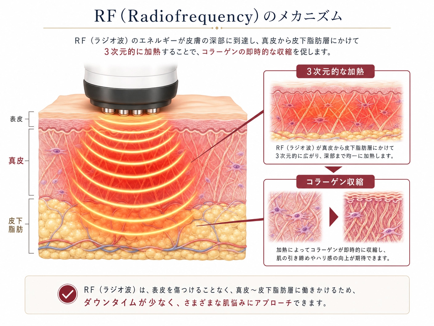 高周波のメカニズム